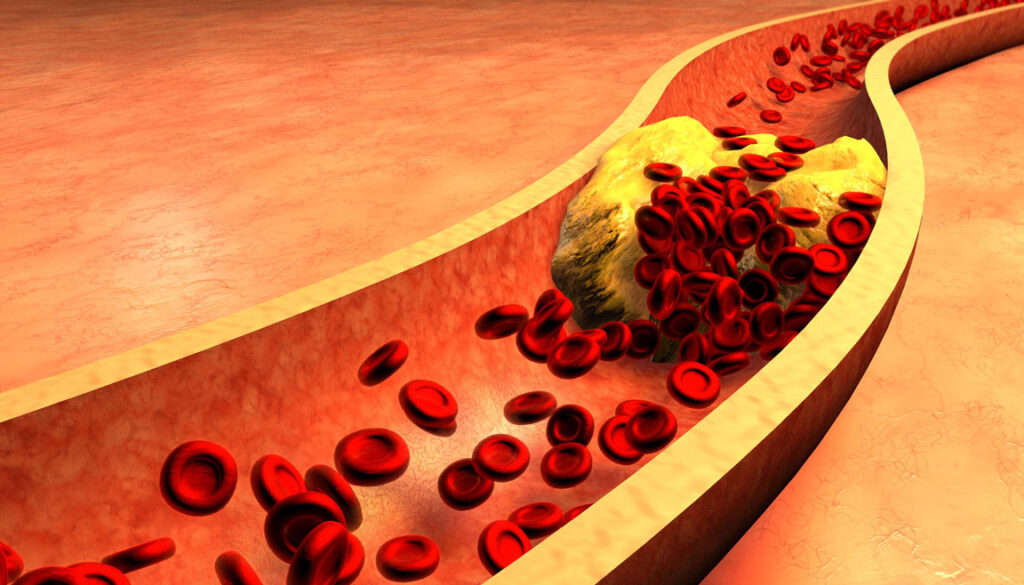 digital rendering of cholesterol build up in arteries