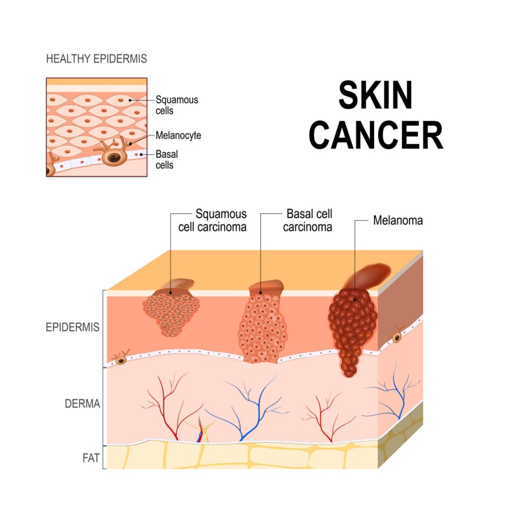 skin cancer diagram