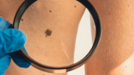 doctor looking for signs of skin cancer